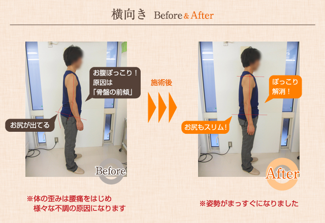 全身矯正（横向き）Before&After（ビフォーアフター）