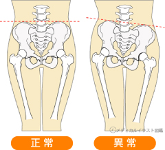 骨盤矯正